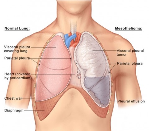 Mesothelioma